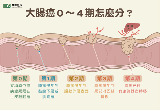 大腸癌0~4期怎麼分