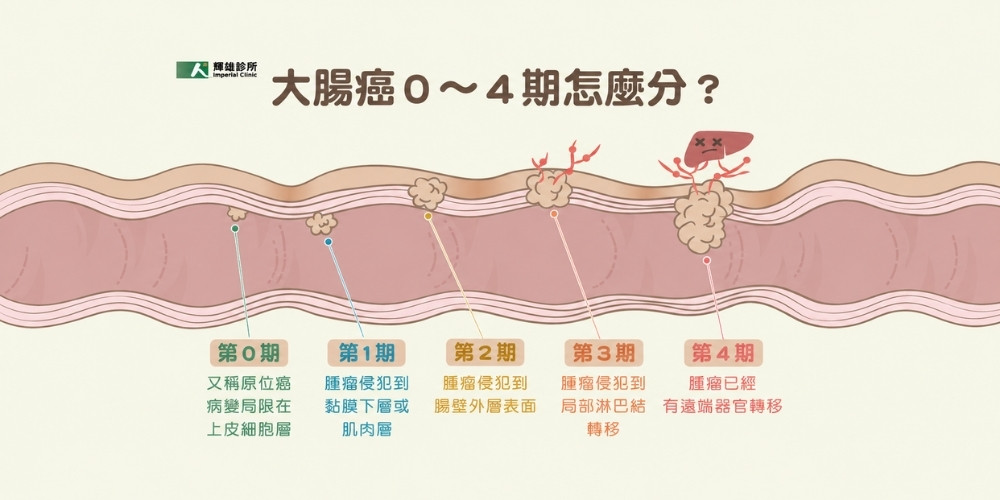 大腸癌期數怎麼分?