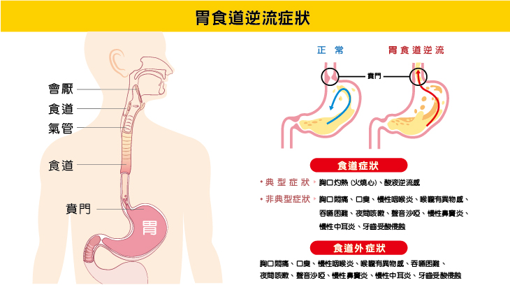 胃食道逆流症狀圖示說明