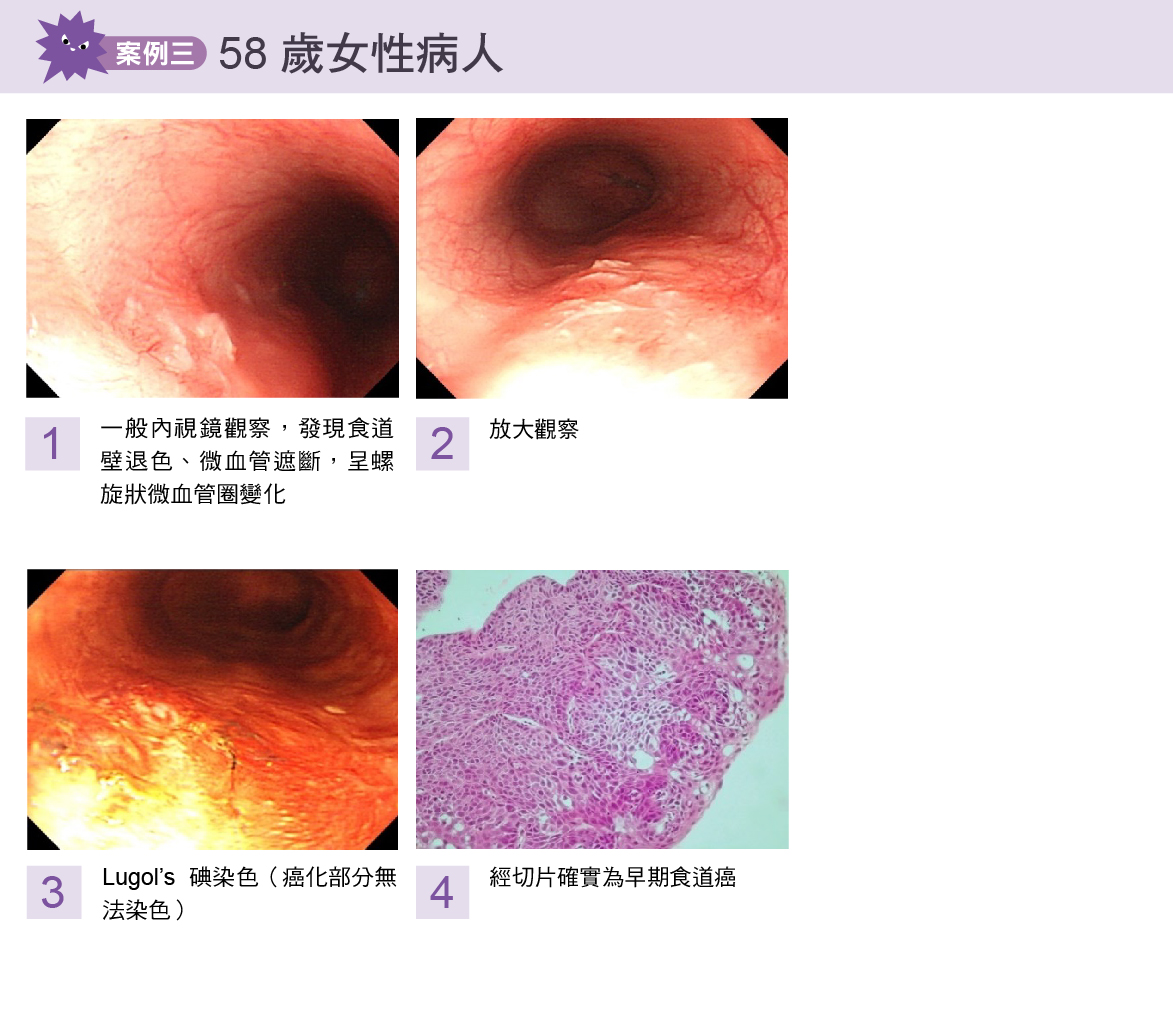 食道癌案例