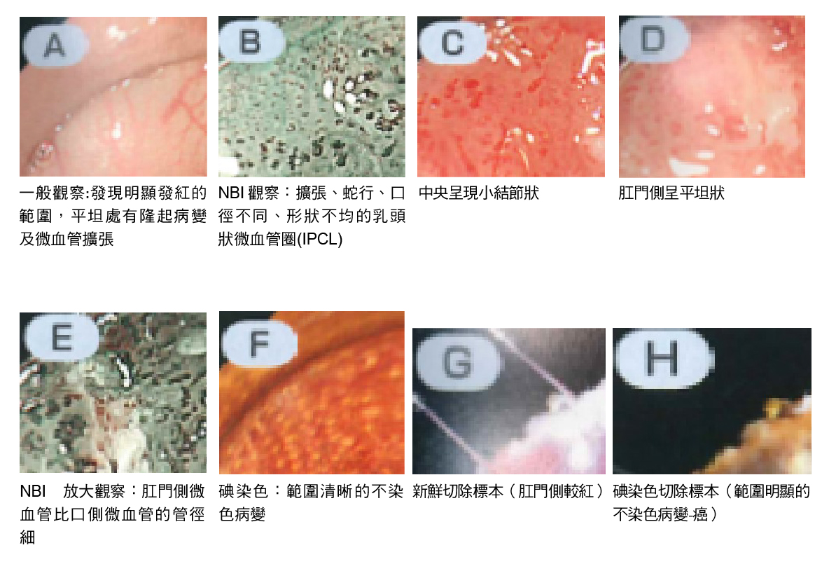 內視鏡早期食道癌診斷