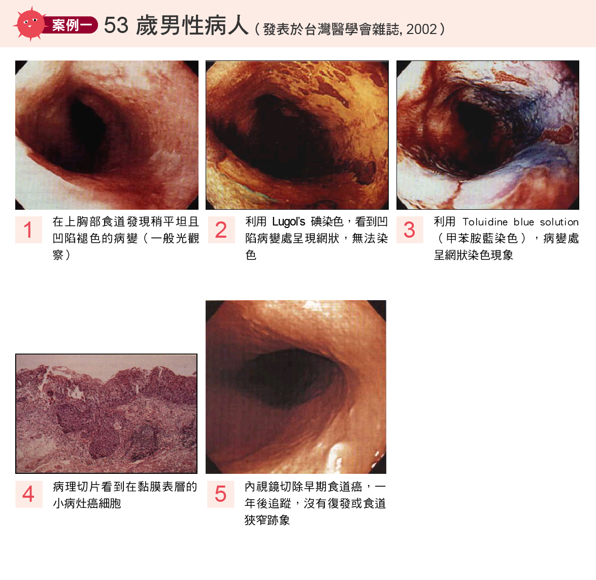 食道癌案例