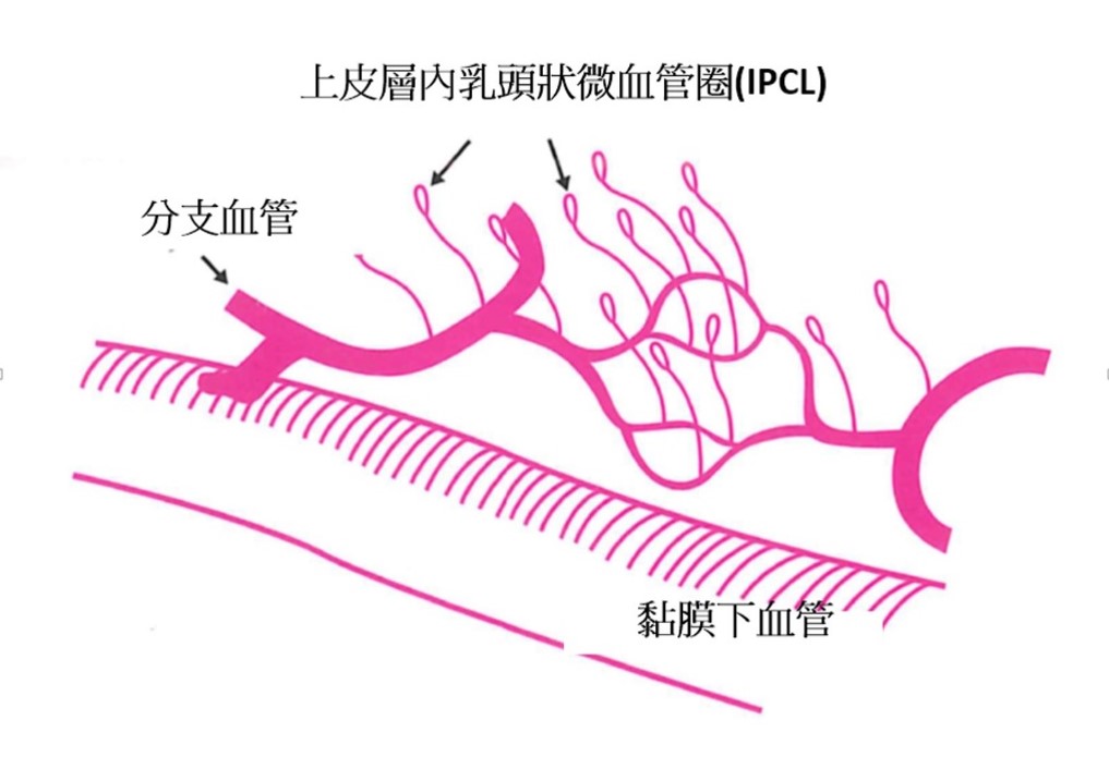 上皮層內乳頭狀微血管圖